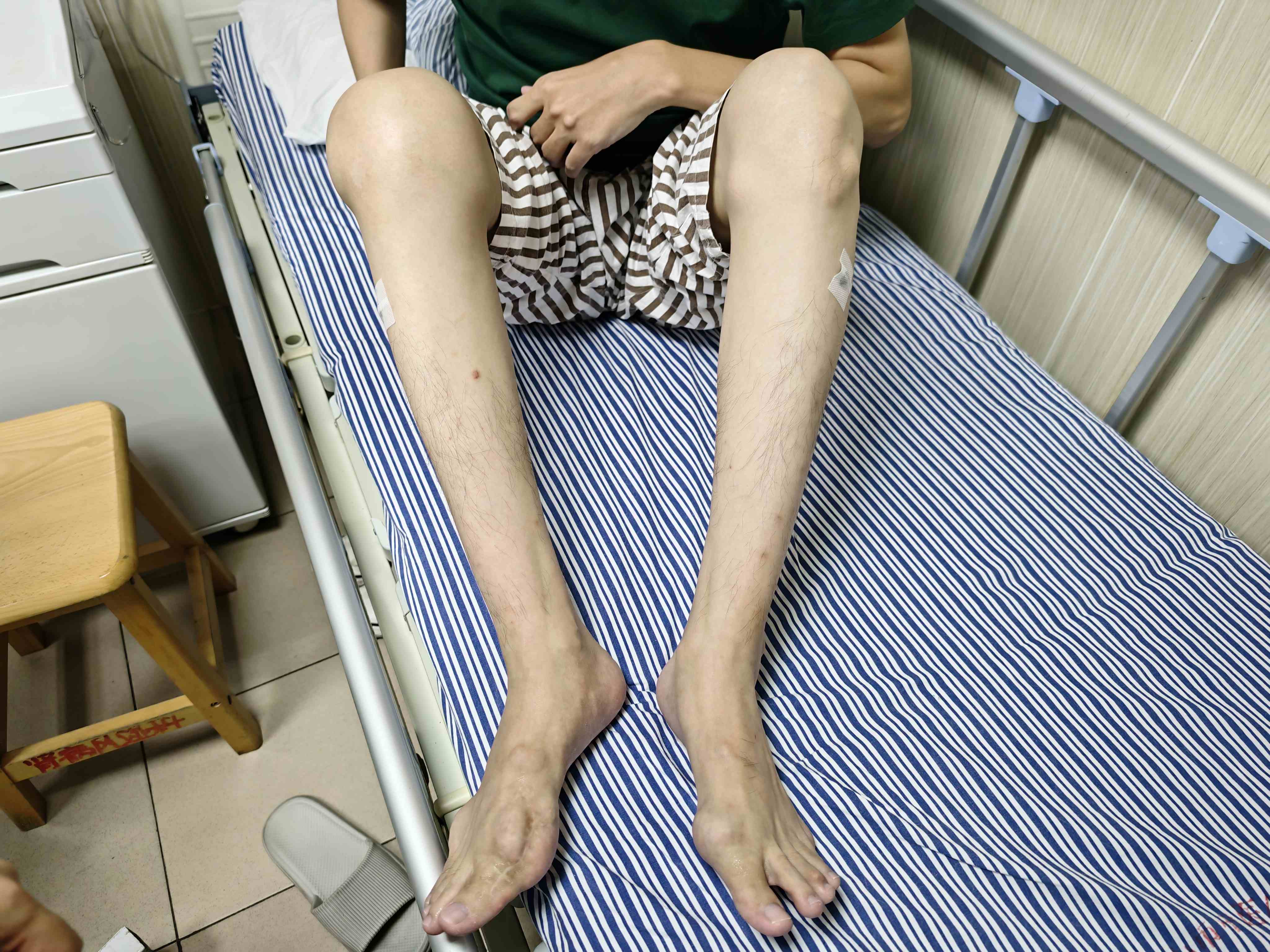 酷爱甜食和碳酸饮料,佛山39岁男子全身多处长满痛风石