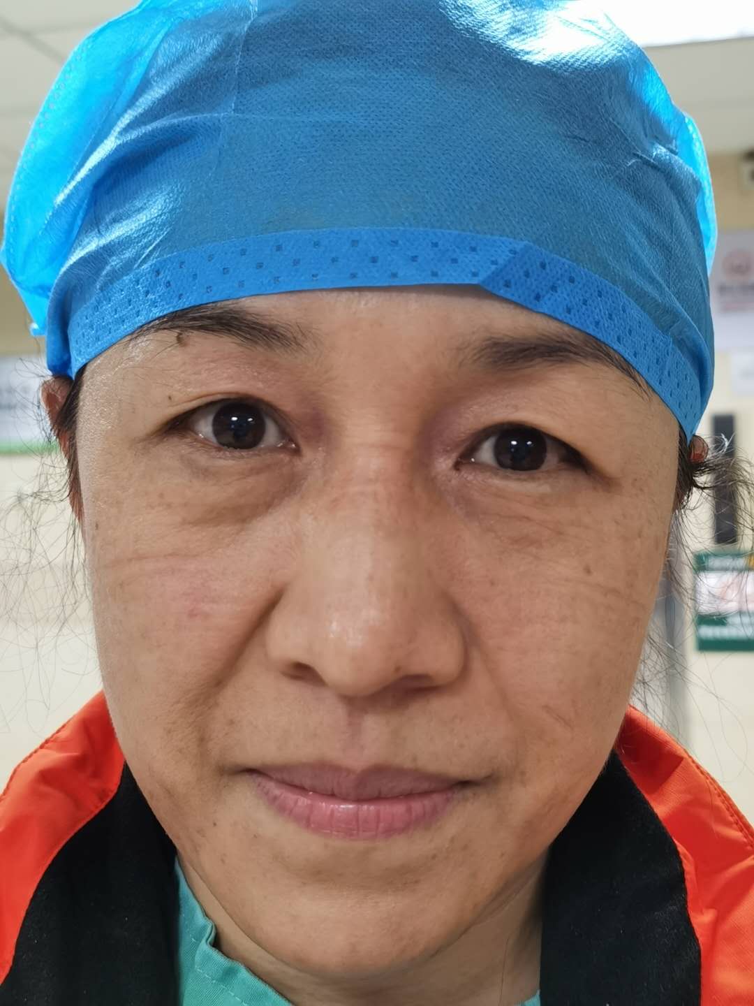 工作完毕脱下防护服和口罩后,佛山医疗队队员的脸满是压痕。