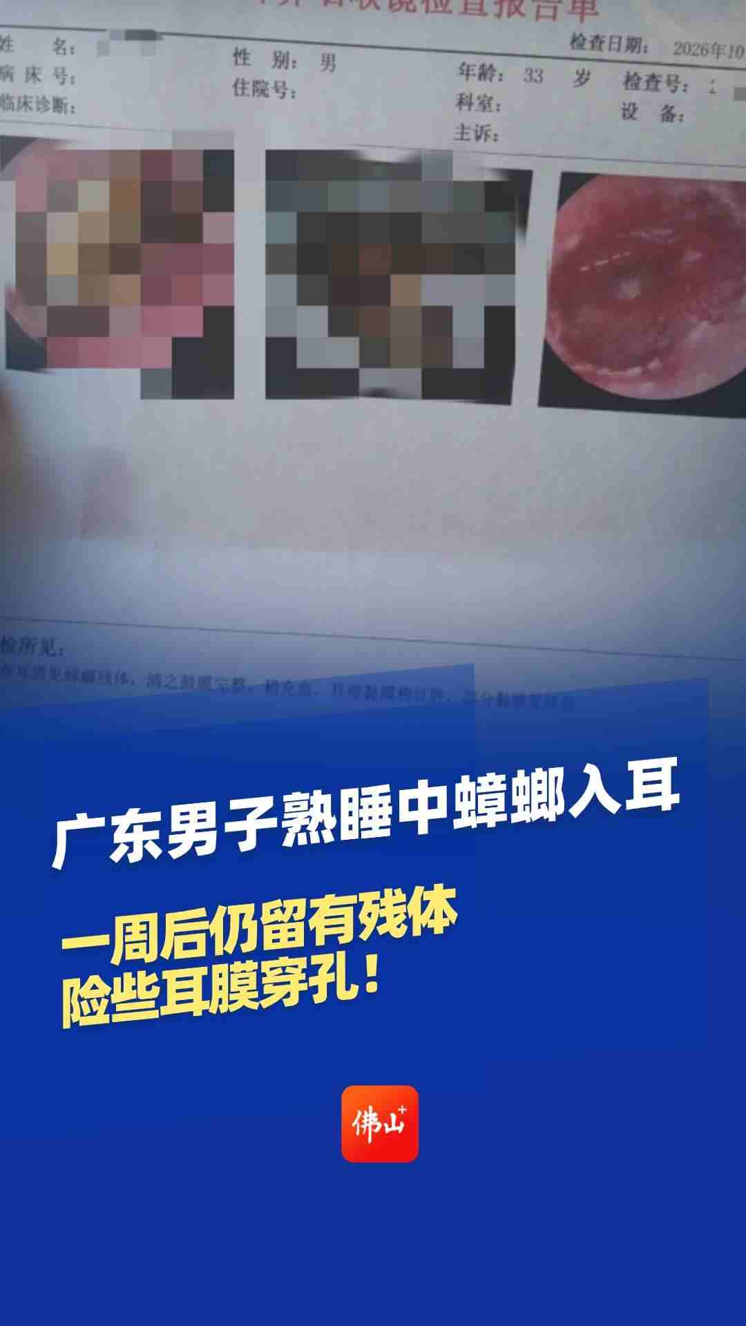 广东男子熟睡中蟑螂入耳，一周后仍留有残体，险些耳膜穿孔！