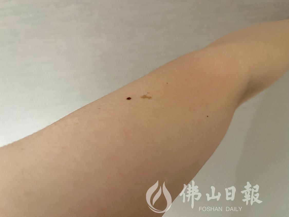 多数黑痣为良性,边缘整齐、均匀,呈黑色或深褐色,呈轴对称状。佛山市新闻传媒中心记者陈嘉懿摄.jpg