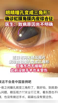 眼睛瞳孔变成三角形！确诊虹膜角膜内皮综合征 ，医生：致病原因尚不明确