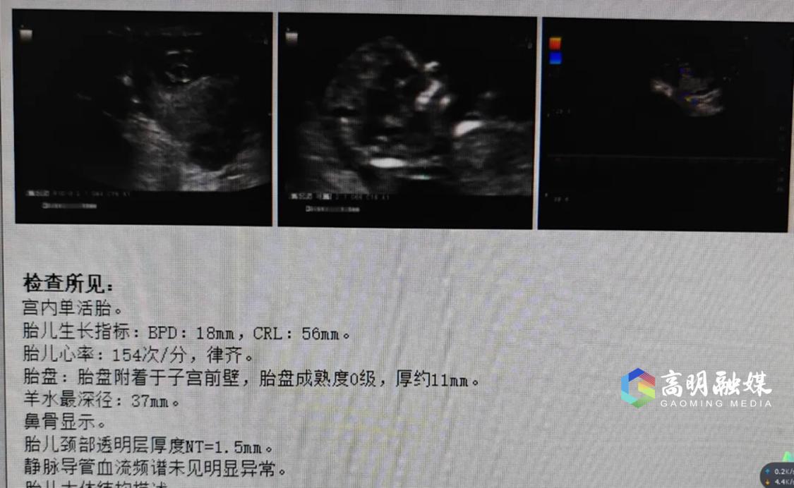 患者小青(化名)经过两院专家的治疗,顺利经IVF-ET(体外受精)助孕成功,这是两院今年共建生殖健康与不孕门诊以来的首例试管婴儿。医院供图.png