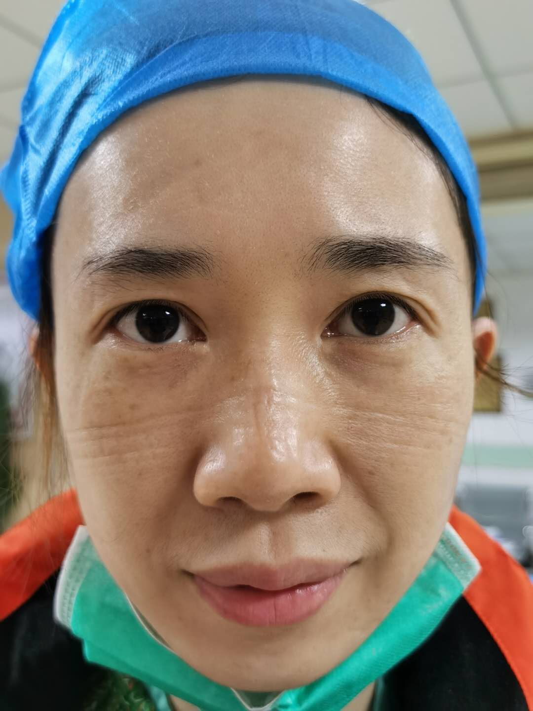 工作完毕脱下防护服和口罩后,佛山医疗队队员的脸满是压痕。