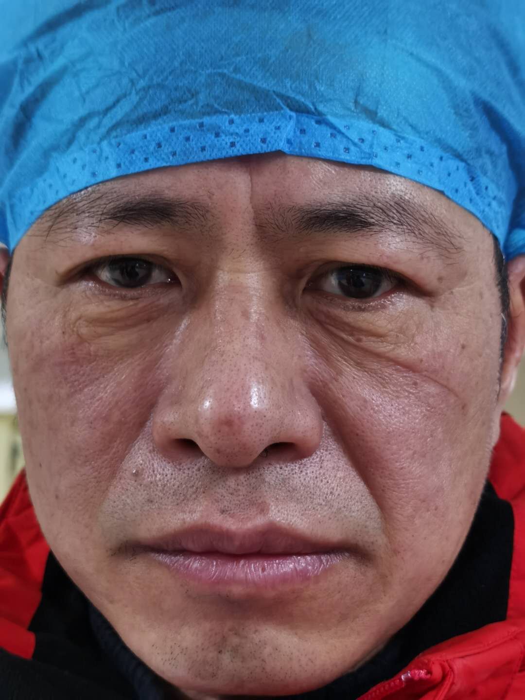 工作完毕脱下防护服和口罩后,佛山医疗队队员的脸满是压痕。