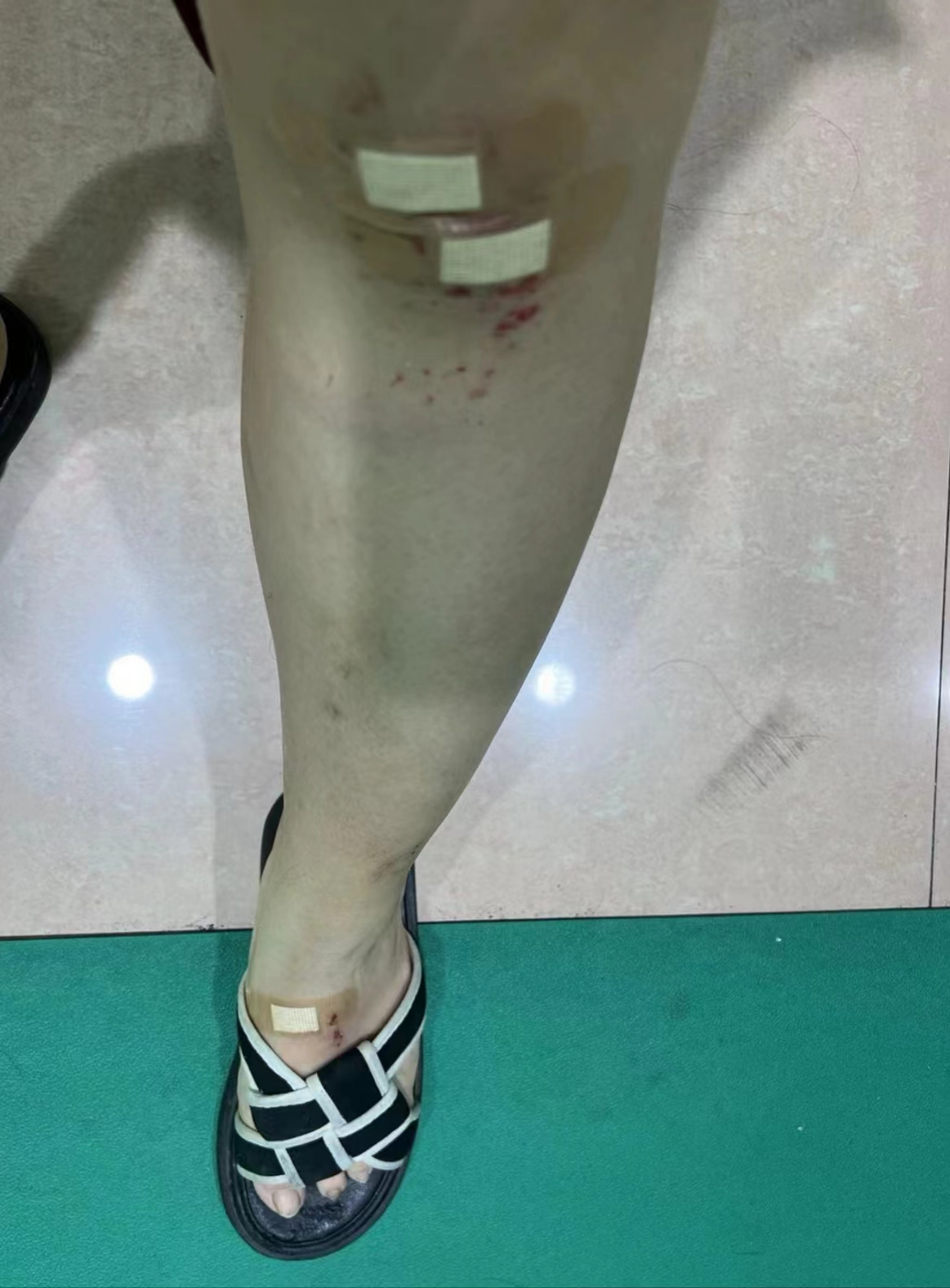 5月25日,何女士被福宴酒家桂城店自设的铁链绊倒,膝盖及脚部受伤。.jpg